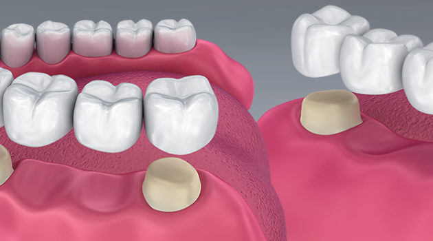 Fixed Teeth(Crown and Bridges)