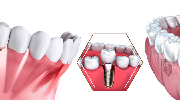 Dental Implants