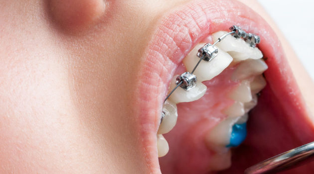 Orthodontic Treatment/Braces