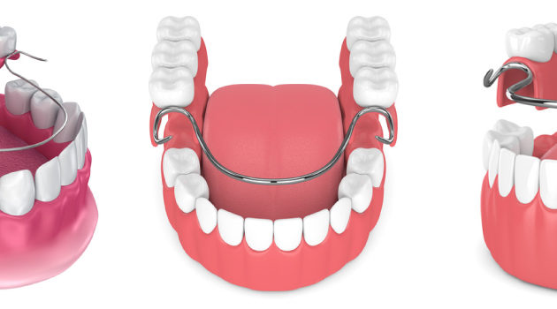 Removable Partial Denture